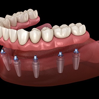 A 3D illustration of implant dentures