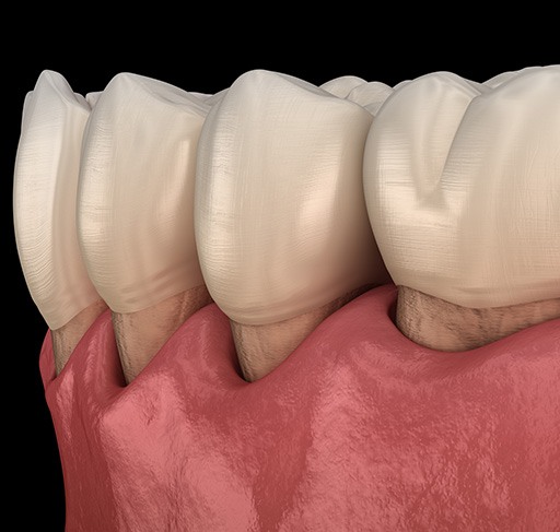 Digital image of gum recession