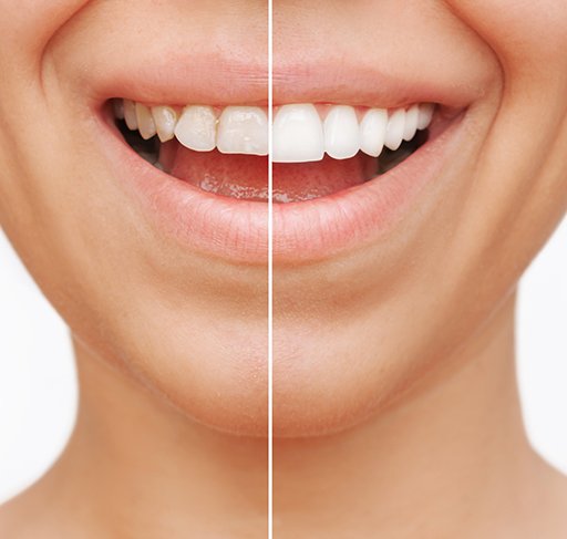 Closeup of patient's smile before and after veneers